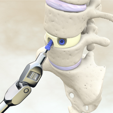 Bild einer Bandscheiben OP
