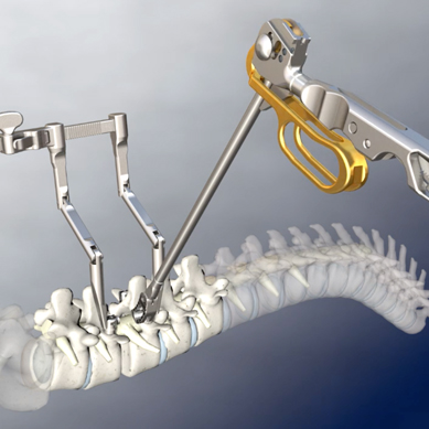 Bandscheibenoperation mit TLIF