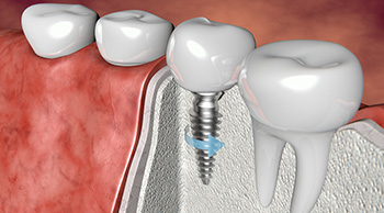 medical 3D modeling